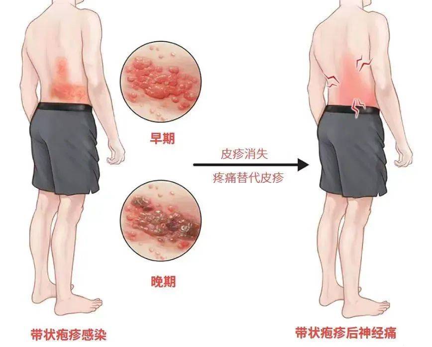 一旦感染终身携带<strong></p>
<p>挖矿比特币</strong>！深圳疾控提醒：这4类人要注意