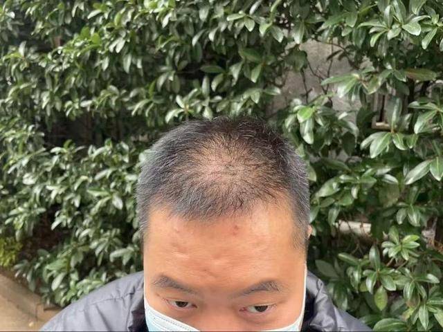 “还能反光<strong></p>
<p>比特币价格今日</strong>！”长沙男子植发近9月称后脑勺“像狗啃过”