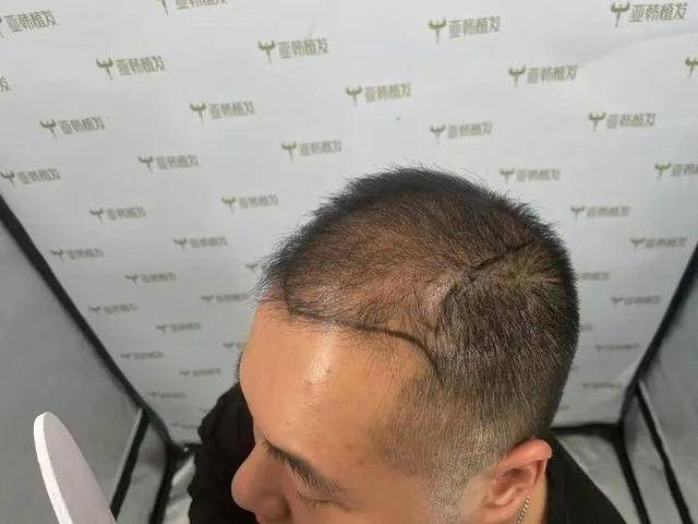 “还能反光<strong></p>
<p>比特币价格今日</strong>！”长沙男子植发近9月称后脑勺“像狗啃过”
