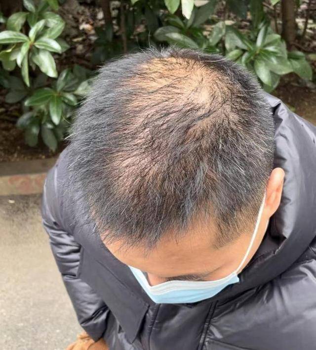 “还能反光<strong></p>
<p>比特币价格今日</strong>！”长沙男子植发近9月称后脑勺“像狗啃过”