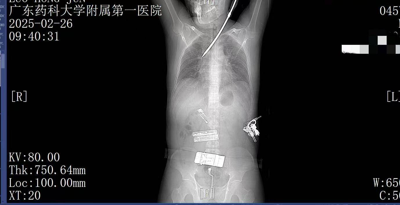 20米高空掉落螺丝刀直插男子胸腔<strong></p>
<p>原油市场分析</strong>！医生：不要自行拔除