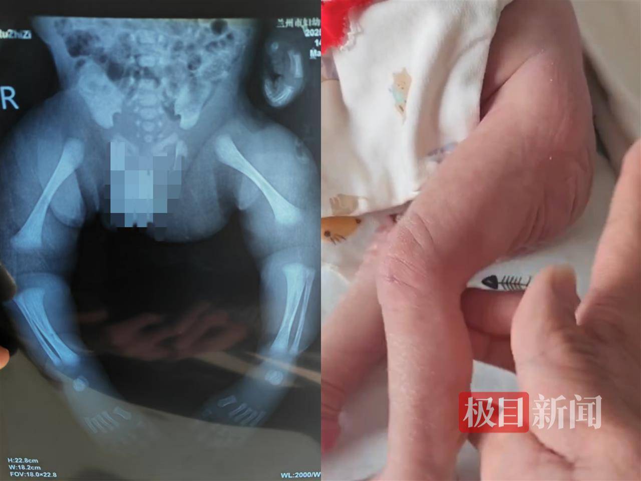 二胎出生查出先天性病症或落下残疾<strong></p>
<p>荣原油</strong>，残疾父母称医院产检漏检、未尽告知义务，医院及医调委回应