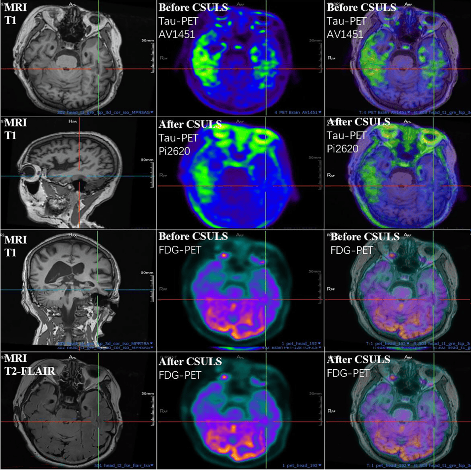 300多家医院抢着做的手术<strong></p>
<p>原油苯</strong>，为何突被禁？