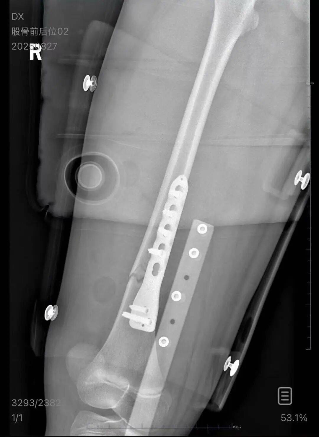 男子火车上铺跌落砸断10岁女孩腿骨<strong></p>
<p>XRP行情</strong>,回应“失联”称失业讨薪中
