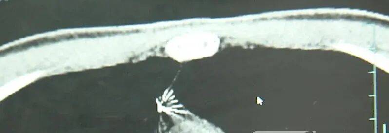 17岁小伙参军体检发现胸腔内有根5cm缝衣针<strong></p>
<p>虚拟货币ico</strong>，父母回忆或是1岁时扎入，取出时已锈迹斑斑