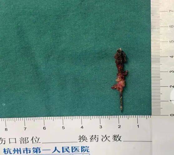 17岁小伙参军体检发现胸腔内有根5cm缝衣针<strong></p>
<p>虚拟货币ico</strong>，父母回忆或是1岁时扎入，取出时已锈迹斑斑